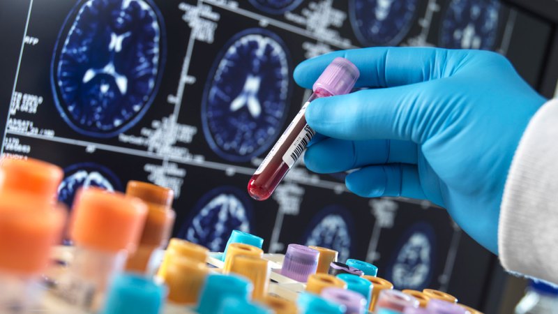 AI-Assisted Blood Test Detects Overlapping Dementias